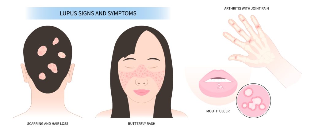 signs of lupus