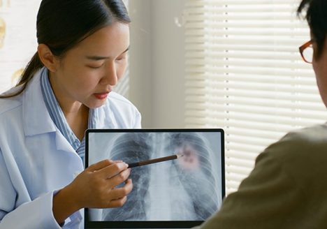 lung cancer facts