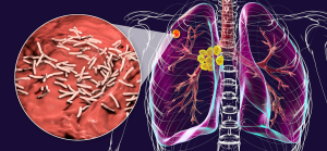 Tuberculosis symptoms