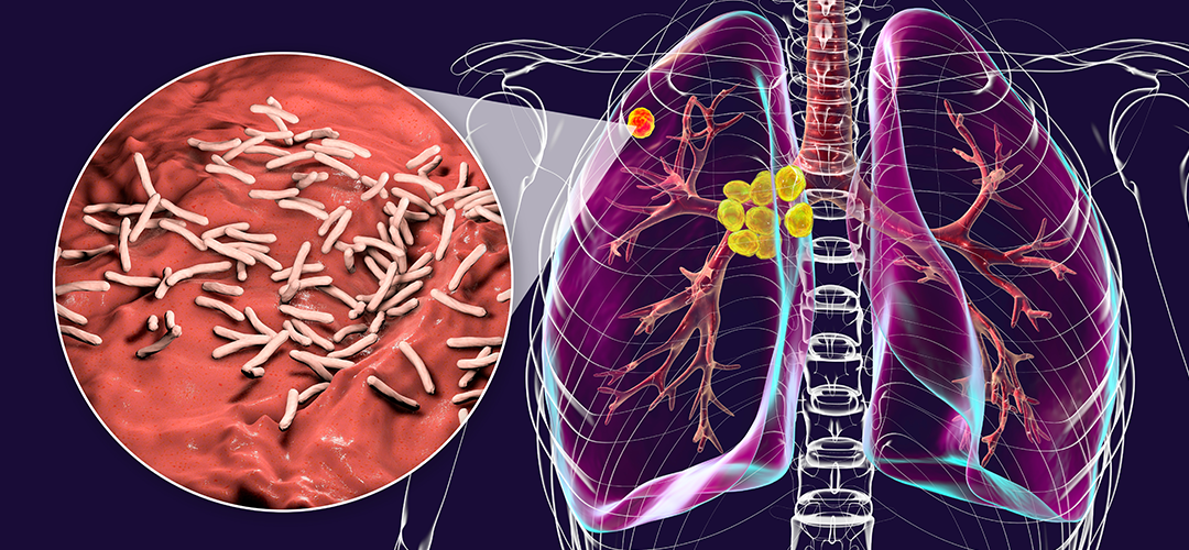 Tuberculosis symptoms