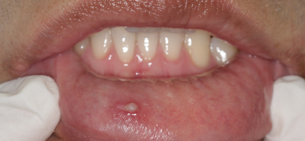 HPV Symptoms
