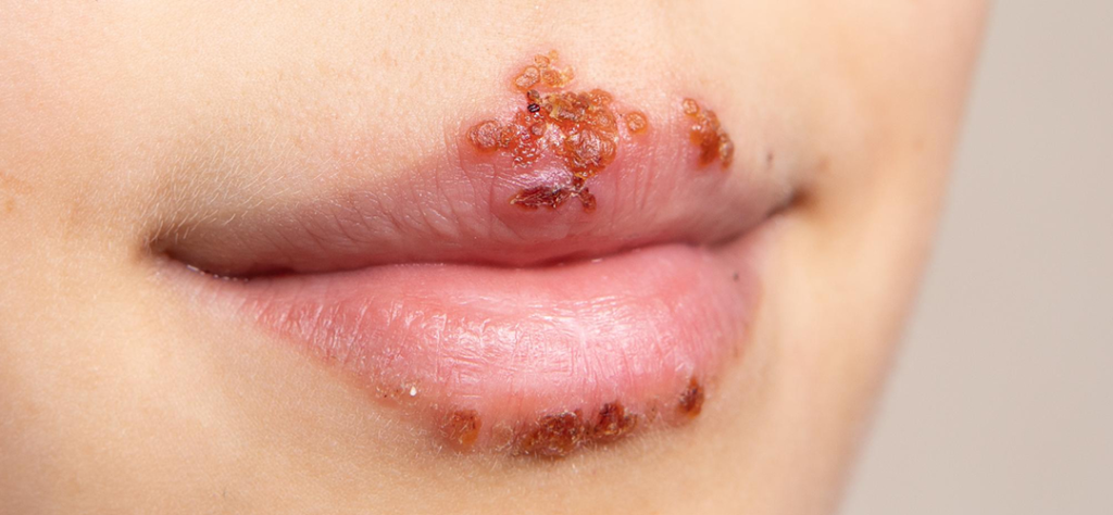 Herpes Symptoms
